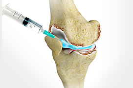 Cortisone Injection