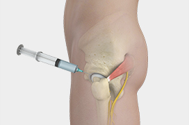 Hip Injections