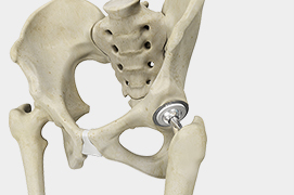 Outpatient Hip Replacement