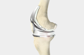 Outpatient Total Knee Replacement