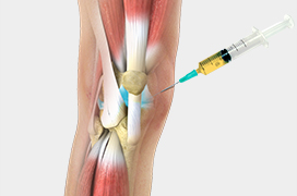 Platelet-Rich Plasma Injection